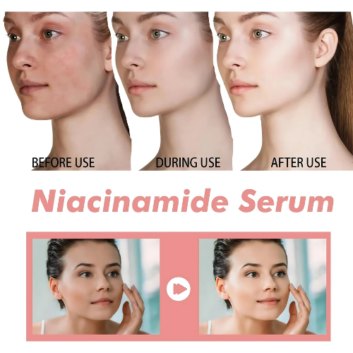  Niacinamide Zinc Oil results for acne-prone skin